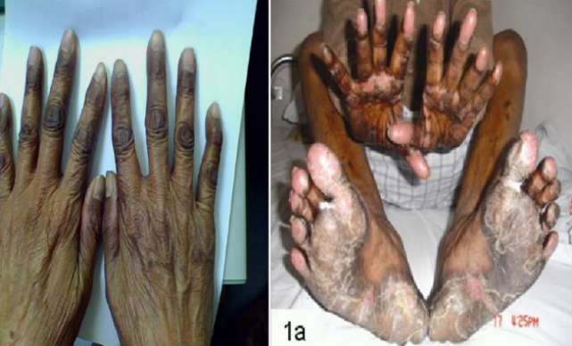 吡咯替尼艾瑞妮使用中常见问题及应对措施之手足综合症和皮疹