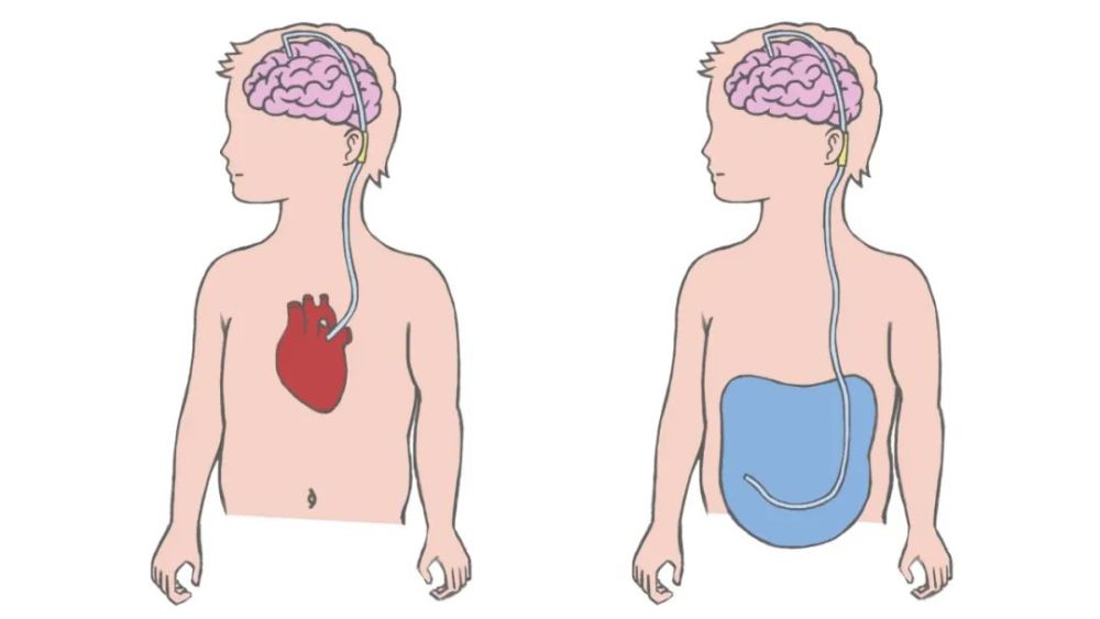 而對於外傷性腦積水,腦室-腹腔分流術是公認的治療方法.