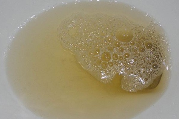 男人尿液多泡沫,是不是得了尿毒症?这,就是医学盲点.