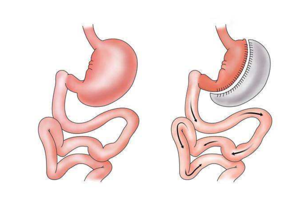糖尿病|明星经纪人为治糖尿病“切胃”，如此控制体重可行吗？