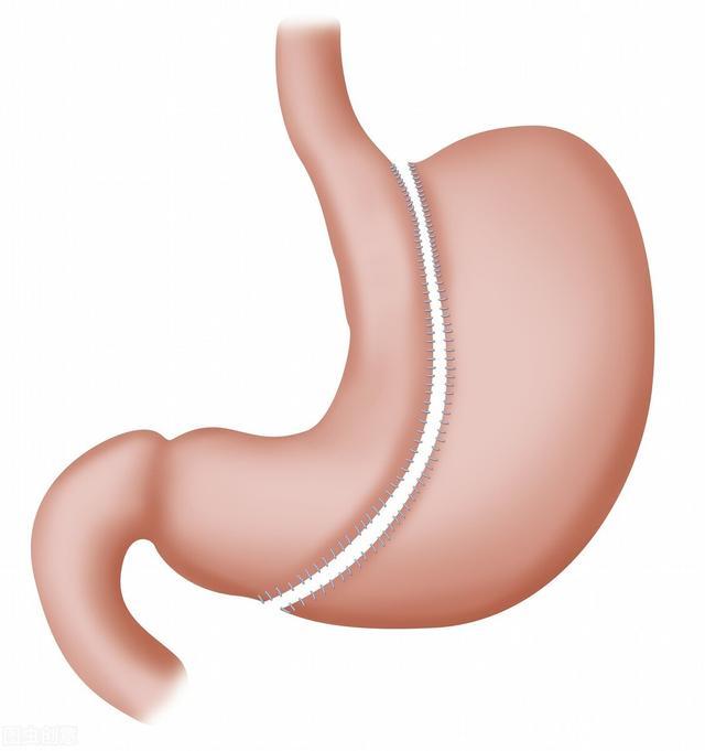 杨天真|杨天真自曝将切胃减重！肥胖人群的好选择？先了解清楚再说