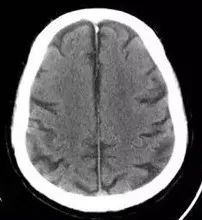 解剖|解惑:放射冠与半卵圆中心的区别