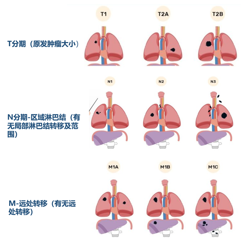 肺癌种类图片
