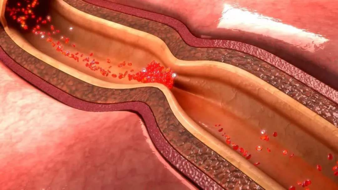 输液|定期输液真的可以“打通”血管吗？