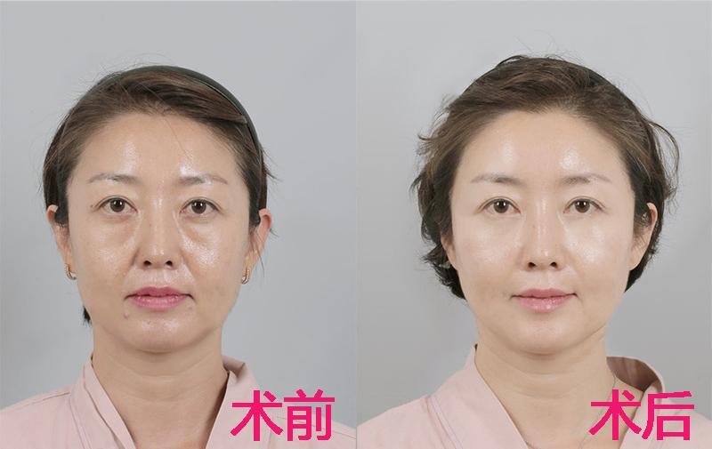 今年40多岁了,迷你小拉皮和大拉皮该如何选择?