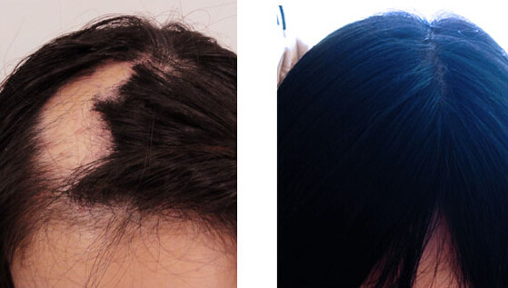 恒美植发 疤痕植发效果怎么样 植发的时候要注意什么 疤痕植发 疤痕 头皮 恒美