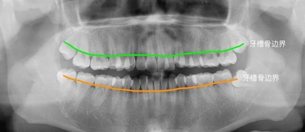 牙周条件好不好,最直观的方法就是检查牙齿周围的牙槽骨"水平线"的
