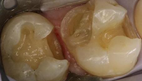 牙齿残根不痛不痒,为什么医生叫我拔掉?可以不拔吗?|牙齿|残根|医生|