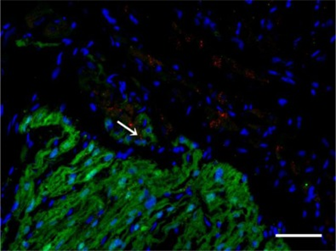 细胞|心脏病干细胞疗法的机遇与五大挑战