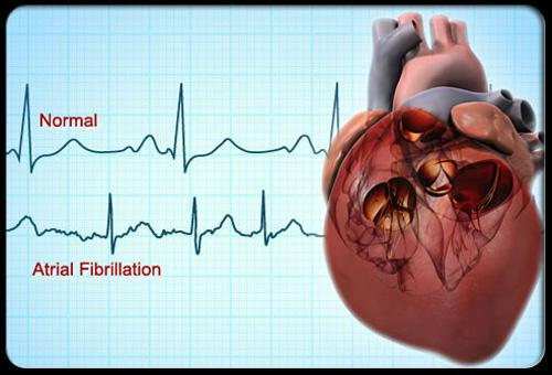 最新調查我國心臟房顫發病率最高這個心臟病導致中風高5倍