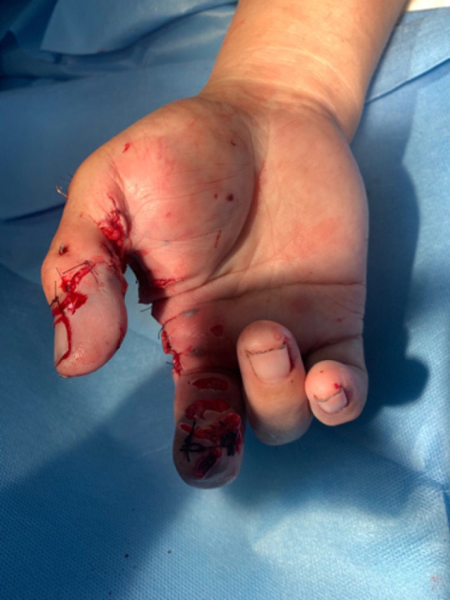 男子用"二踢脚"炸老鼠 右手被炸得血肉模糊