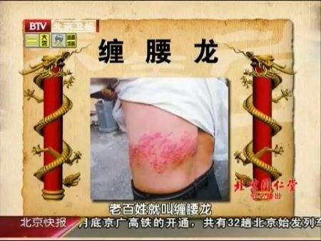 您听说过缠腰火丹吗其实这是病毒引起的