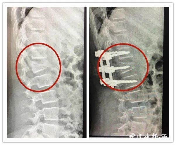 宁波|危险！宁波11岁女孩玩网红游乐项目 结果摔至腰椎骨折…