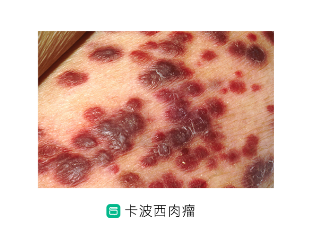 艾滋病|人类免疫缺陷病毒