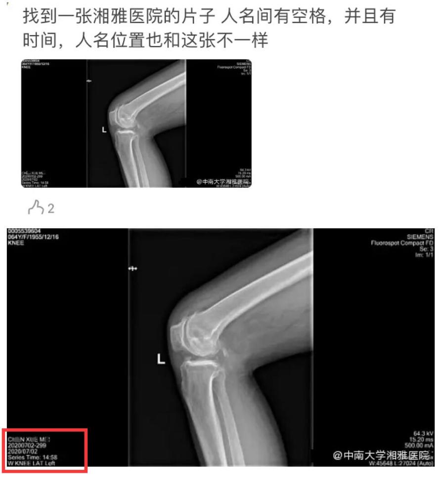 万茜骨折是假的?ct照曝光上下名字不一致,自曝打了钢板却没有刀口