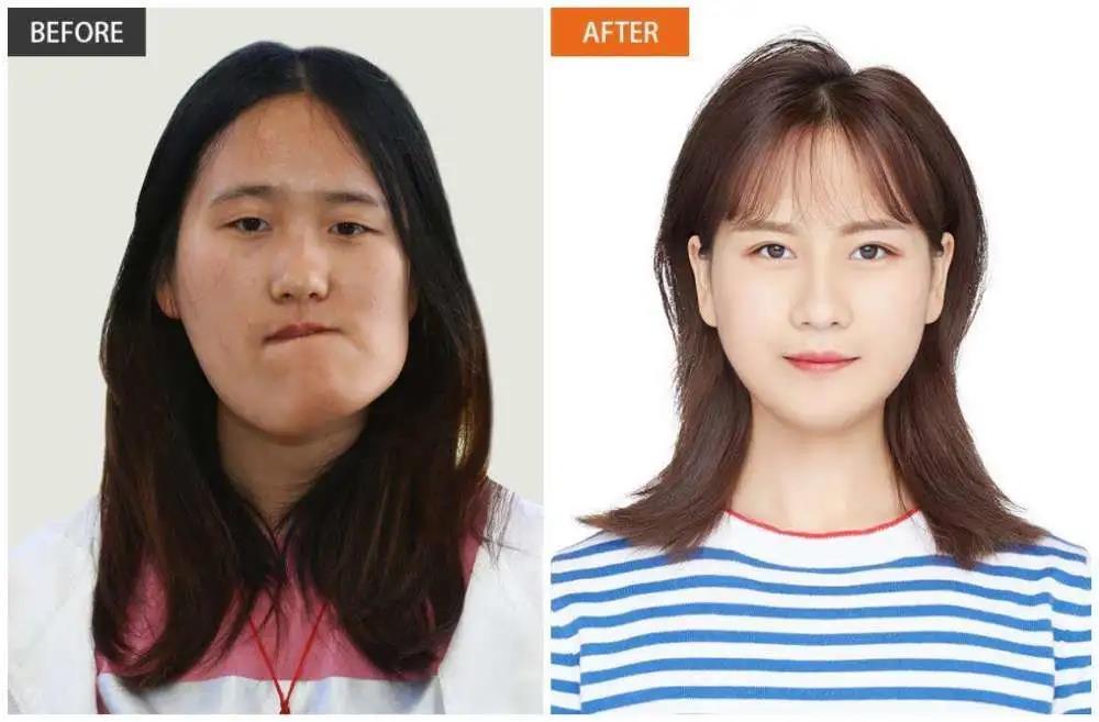 宏秋的术前术后对比图. 图片为采访对象提供