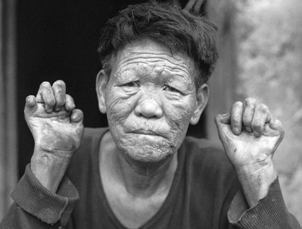 因为麻风病对于病人皮肤和肢体造成损害,所以麻风病人面目会变得丑陋