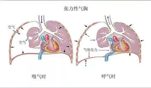 气胸|继发性气胸|气管|慢性阻塞性肺病|阻塞性肺气肿|肺大疱