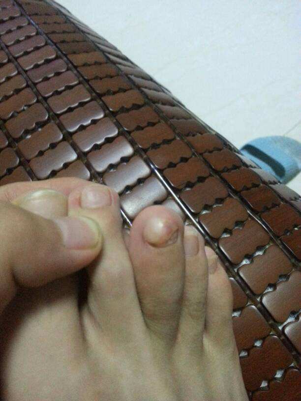 外生骨疣怎么治疗?