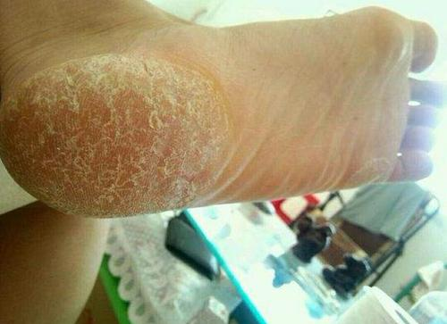 脚气传染到脸上怎么治?