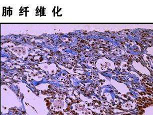 肺纤维化是肺的间质组织发生炎症,引起纤维化的主要原因就是免疫功能