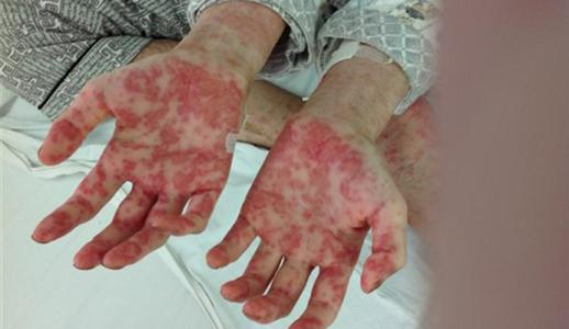 慢性白血病的症状是什么?如何治疗和护理?