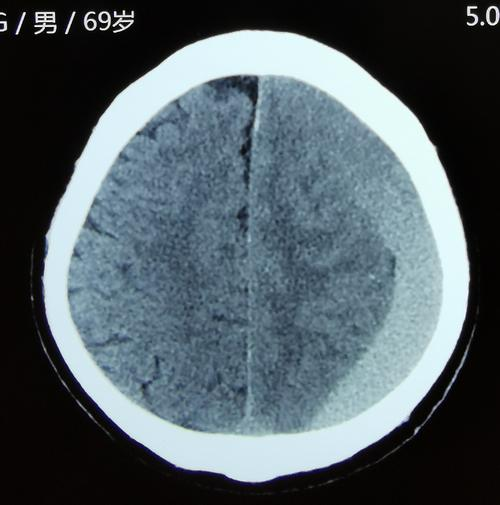 什麼是硬腦膜下血腫手術