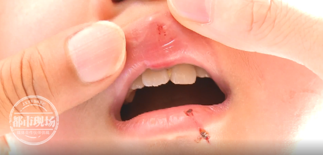 8岁女孩牙根折断牙龈撕裂母亲质疑与酒店地板有关