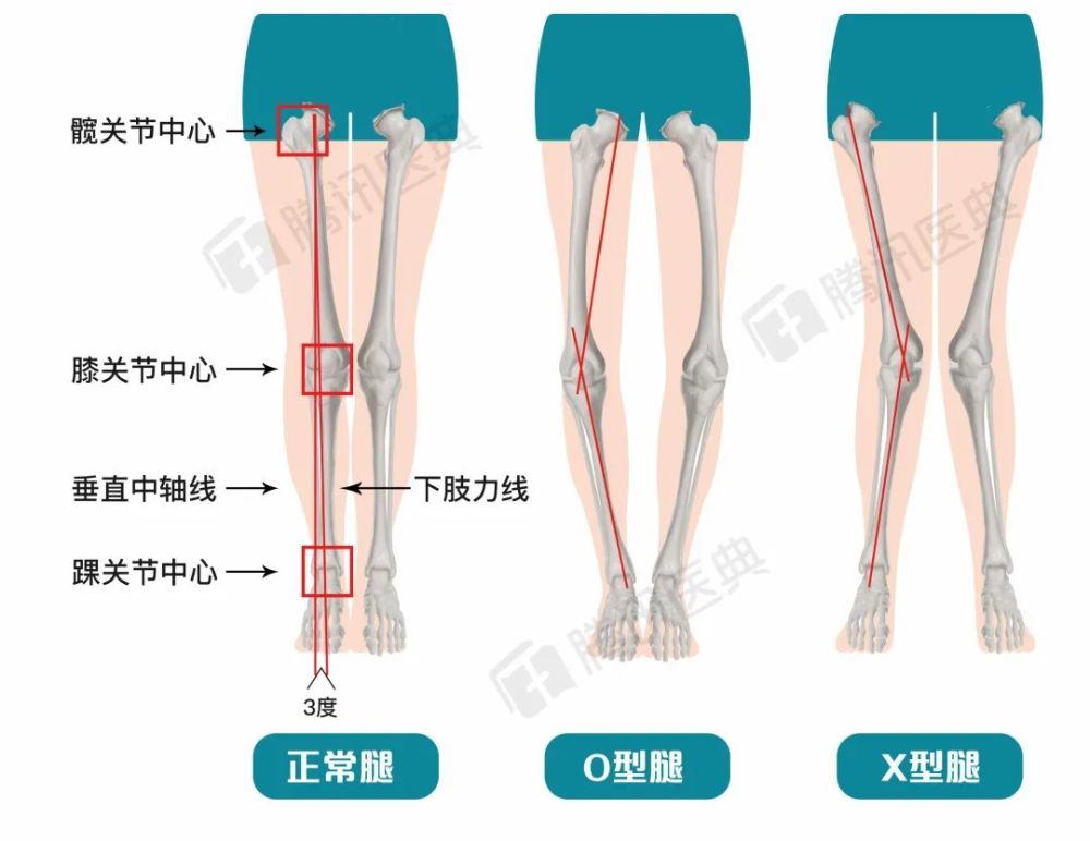 下肢力线测量方法图片图片