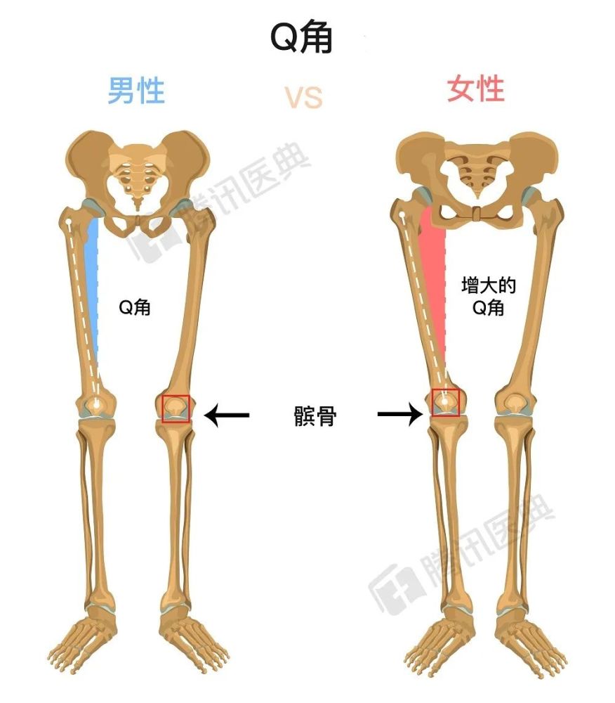 q角是股四头肌和髌韧带之间的夹角(见下图).