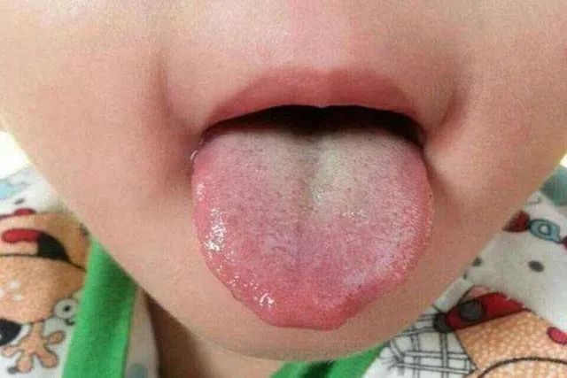 小孩内热舌头图片图片