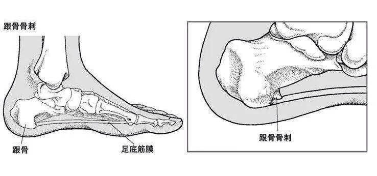 足跟骨刺是什么原因造成的 怎样治疗 腾讯新闻