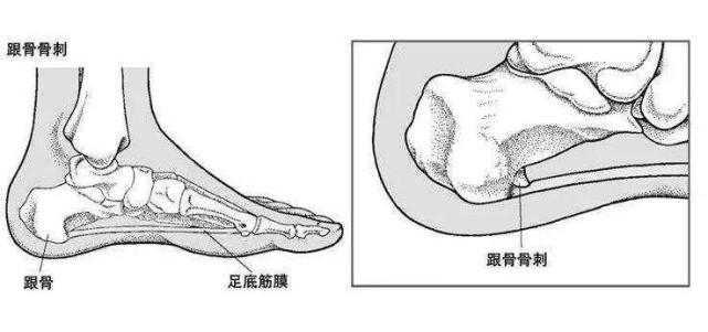 足跟骨刺是什麼原因造成的怎樣治療