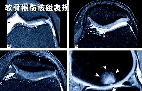 如果您膝盖疼 核磁检查发现关节软骨磨损 不知该咋办 请看此文 腾讯新闻