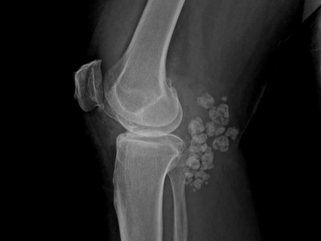 膝关节游离体手术危害 快速问医生