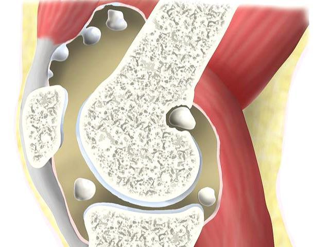 膝关节游离体您听说过吗关节鼠呢医生和您聊聊这疾病吧