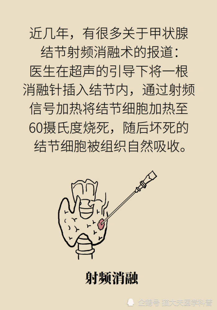 甲状腺结节|去除甲状腺结节，“切”和“烧”哪个好？