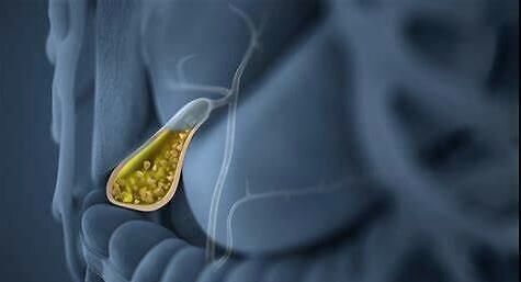 你知道什么是胆囊憩室吗胆囊憩室的发病原因是什么呢