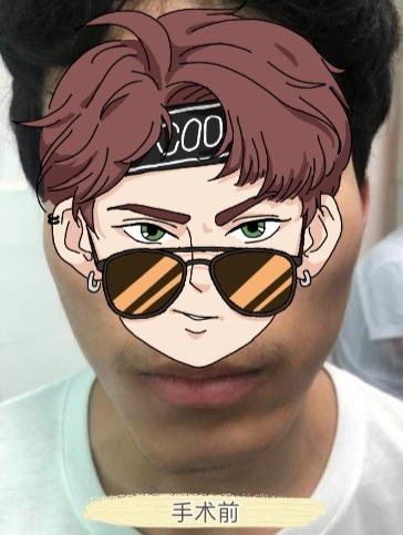 准大学生下巴受伤后变得一高一低,面部轮廓整形治疗重拾信心