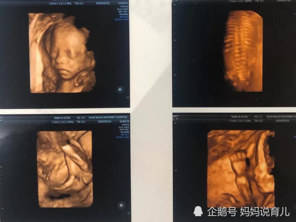 17周胎儿四维彩超图图片