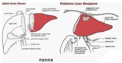 刷新醫學極限!上海仁濟醫院為嬰兒做肝移植