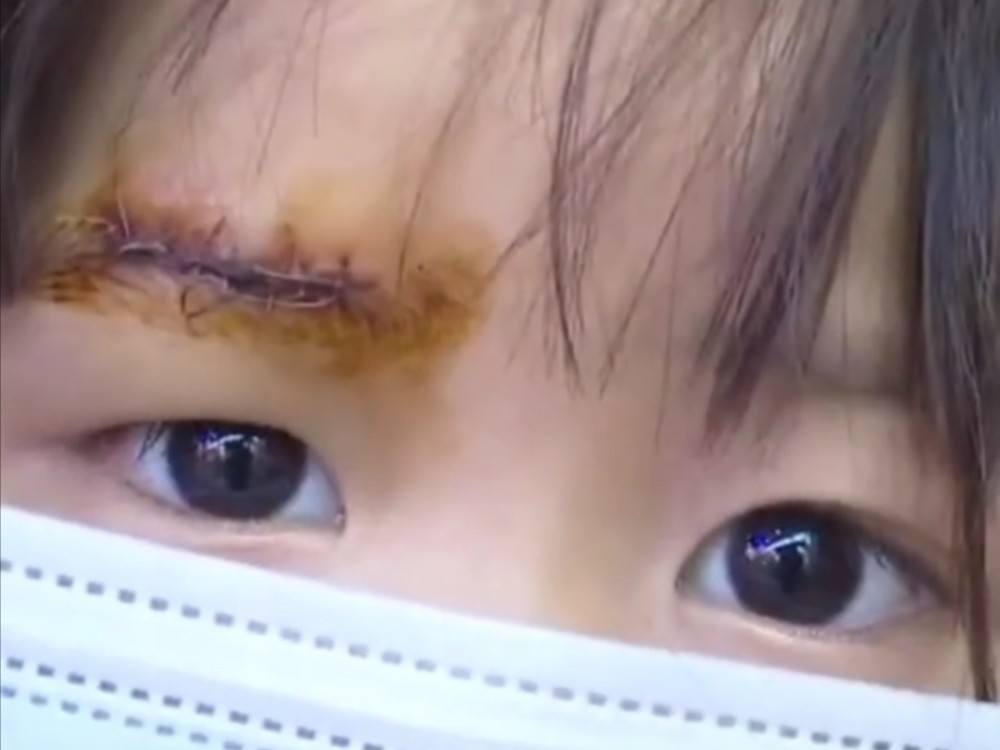 两岁女童从餐厅的沙发上摔下,摔伤眉骨,缝了7针.