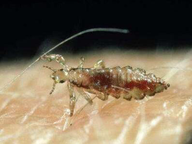 头虱|虮子|虱子