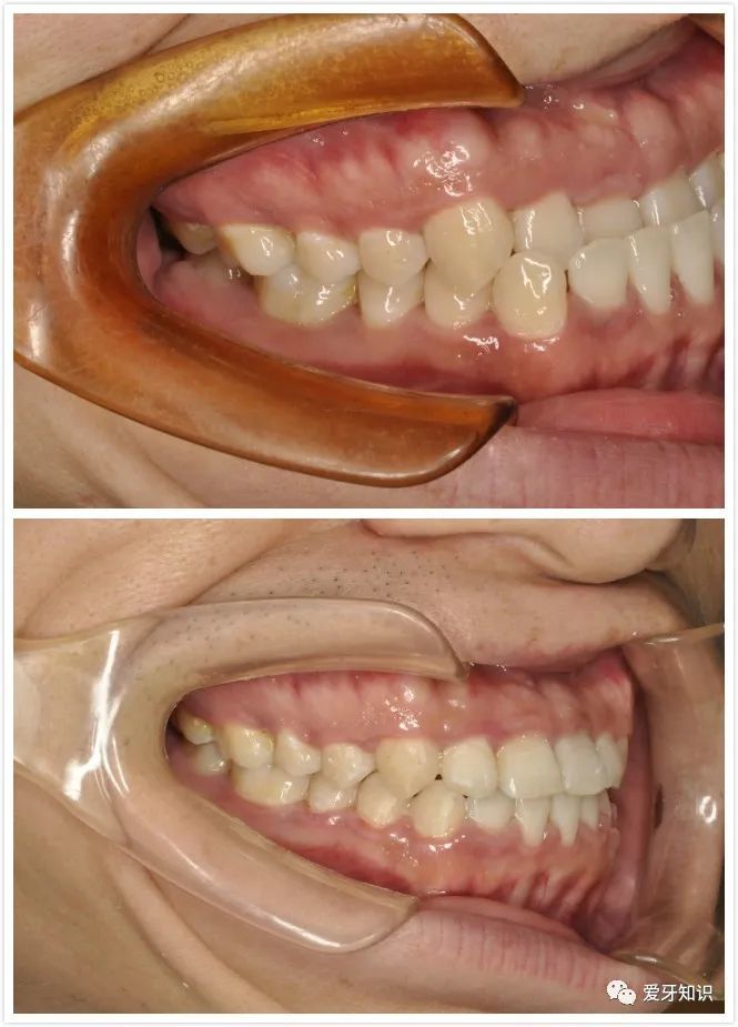 成都口腔科普:牙齿咬合关系不好,有什么影响?