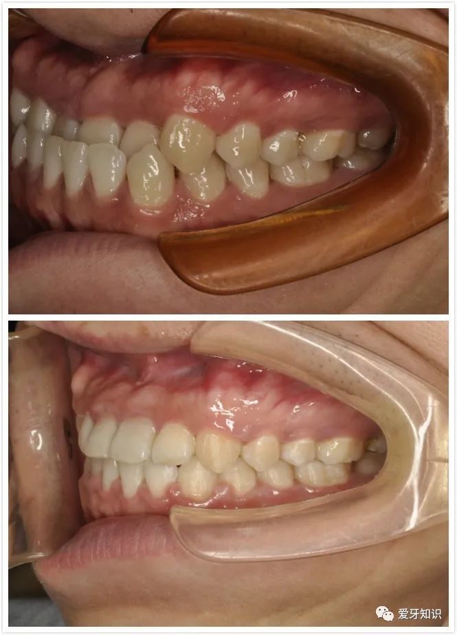 成都口腔科普:牙齿咬合关系不好,有什么影响?