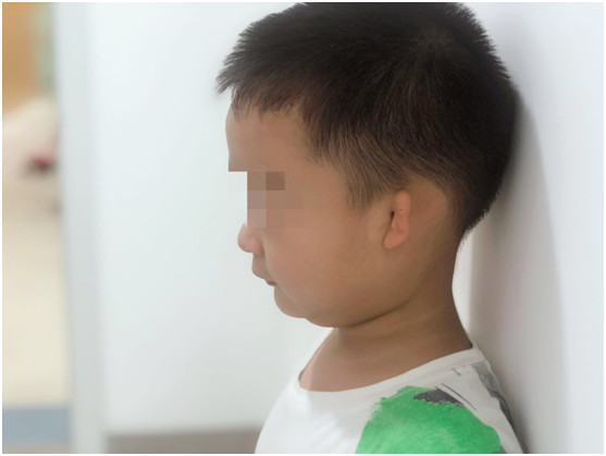 重庆市慈善总会援手又一7岁小耳畸形患儿获益