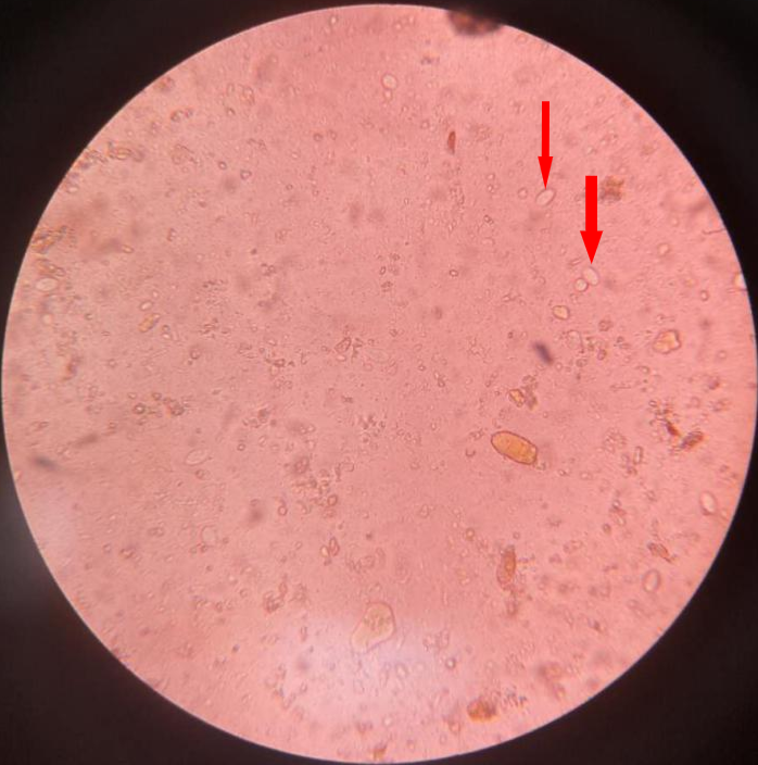 生理盐水涂片后,在低倍镜下我发现了较多个头略比白细胞稍大的椭圆形