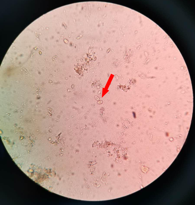 生理盐水涂片后,在低倍镜下我发现了较多个头略比白细胞稍大的椭圆形