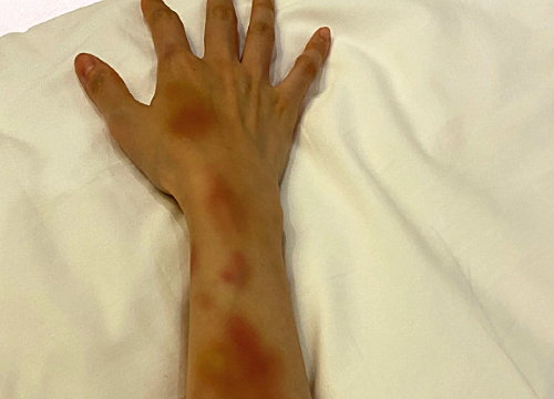陈小纭便在微博当中,晒出了一张自己手臂淤青的照片