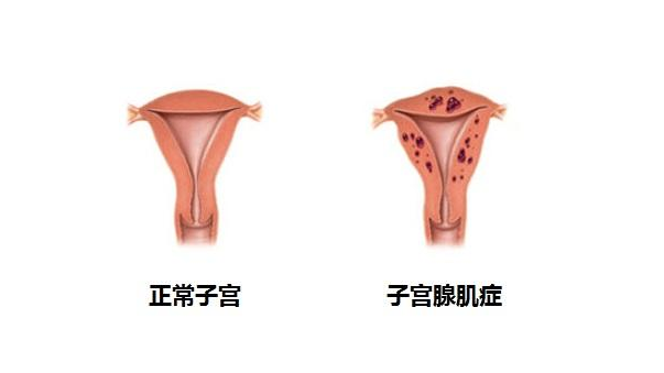"非法移民"是子宫腺肌症的凶手